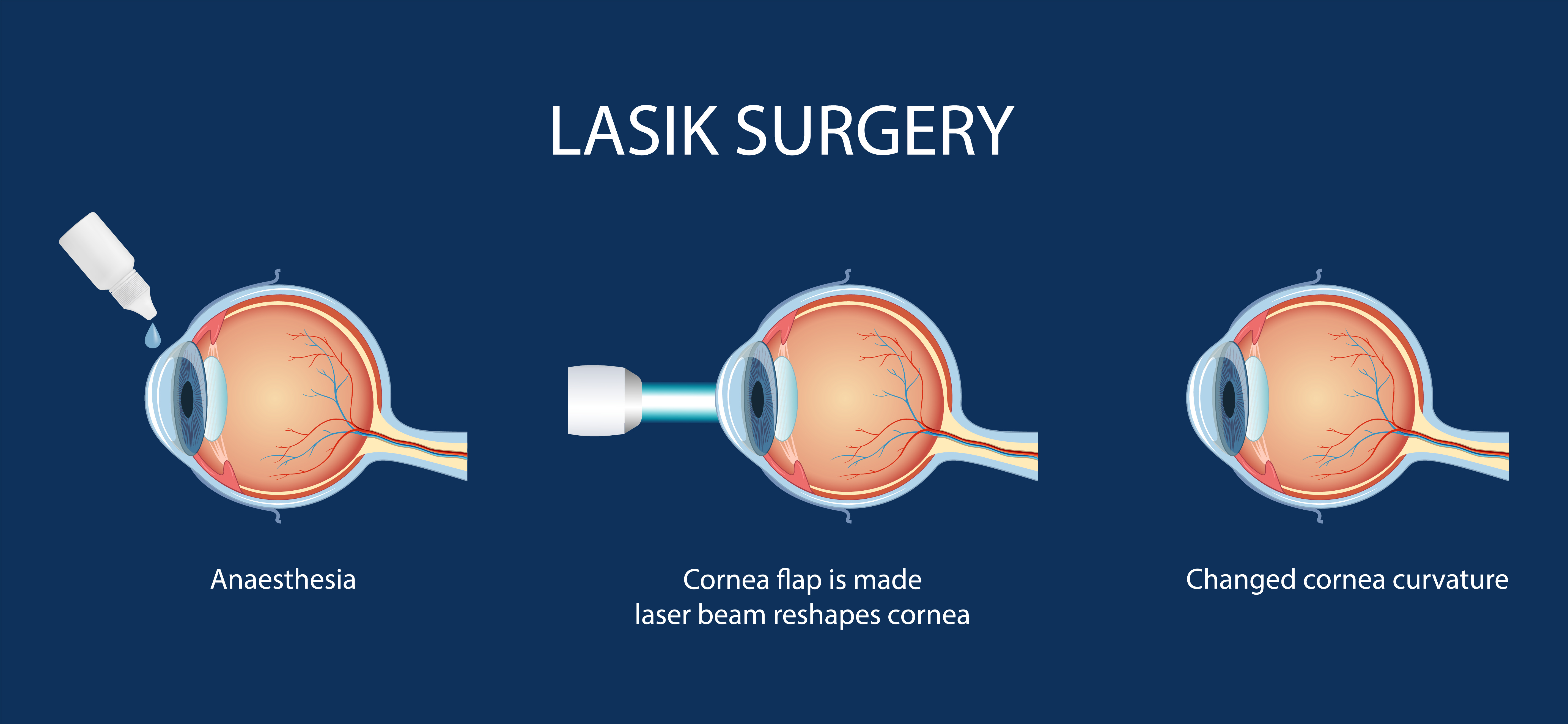 LASIK surgery diagram showing cornea correction procedure